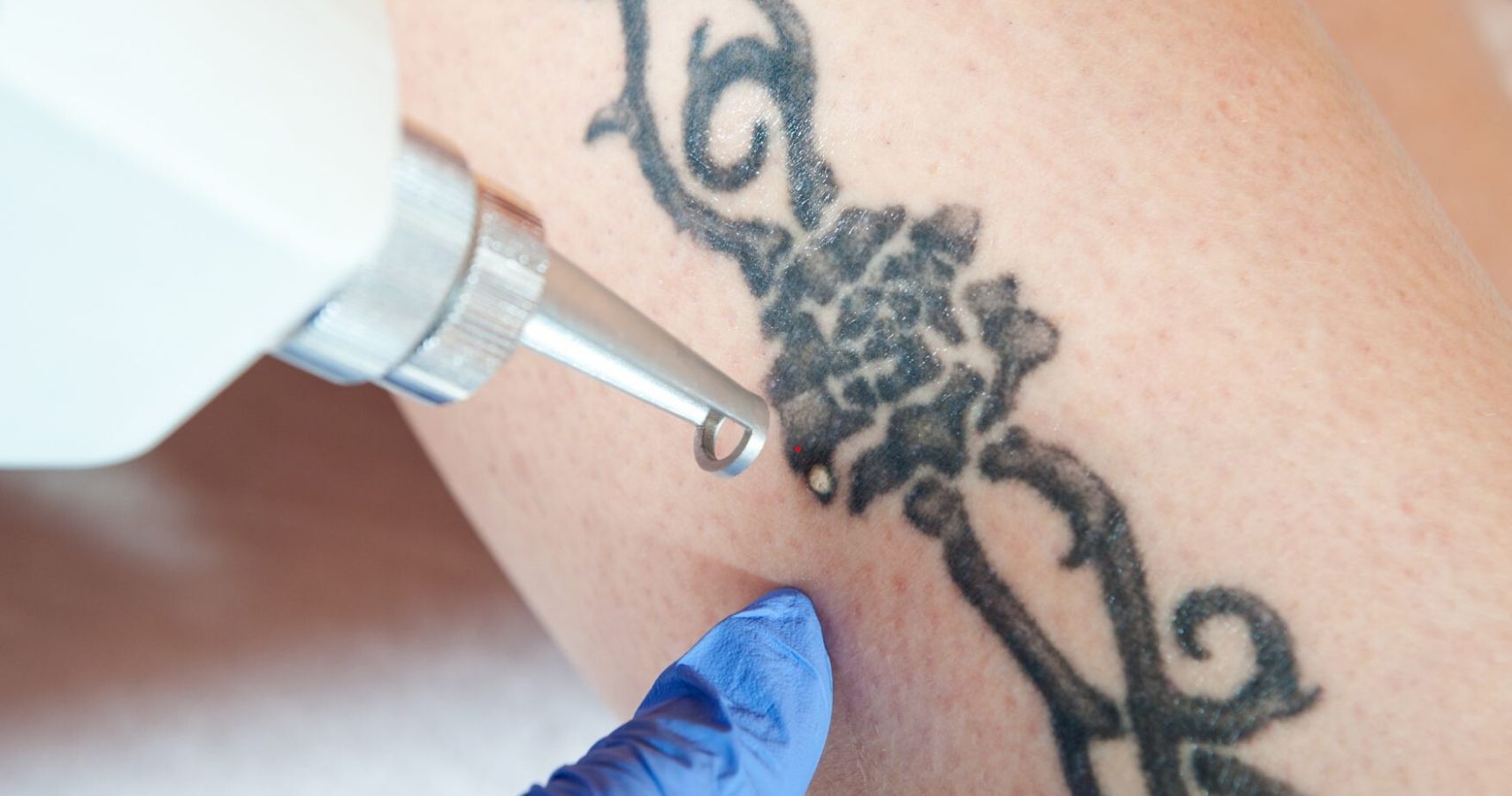 10 Things To Know About Getting A Tattoo Removed | TheTalko